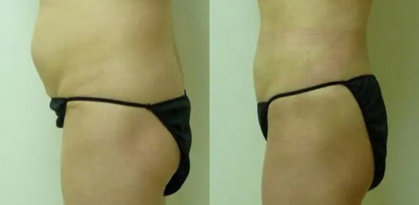 Liposuction at Shine Cosmetic Surgery Serving San Gabriel Valley, West Covina, CA